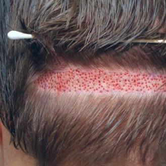 Hair Transplant In Lahore